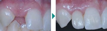bridge implant in ashford|Dental Implants – Ashford Periodontics, Implantology & Endodontics.